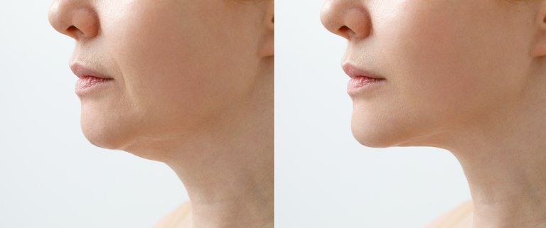 Neck Lift Procedure Chicago