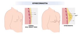 Male breast reduction in Chicago