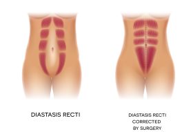 fix rectus diastasis 