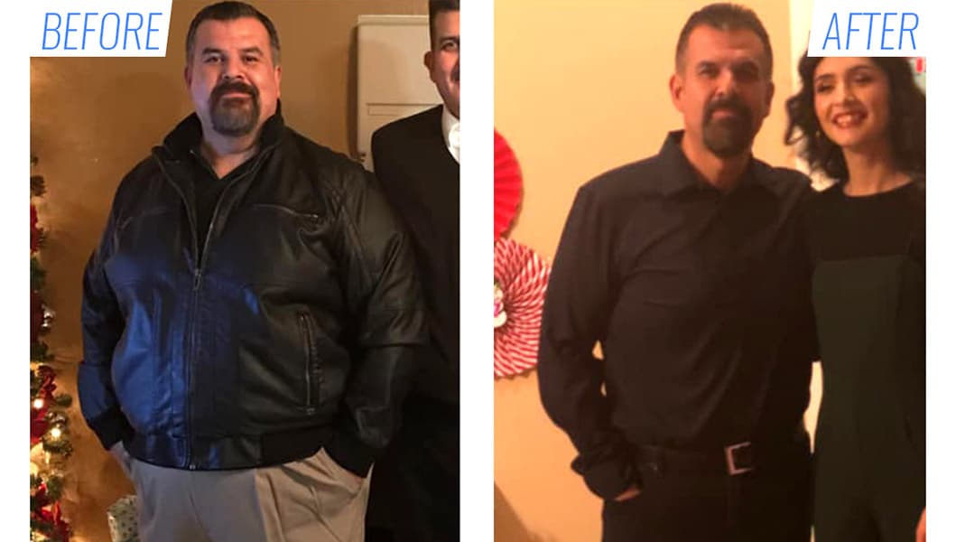 Before & after gastric sleeve surgery in Mexico