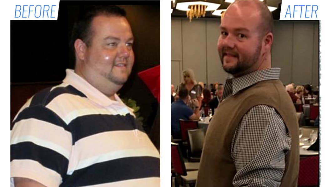 Before & after bariatric surgery in Mexico