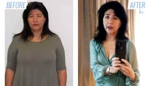 Before & after gastric sleeve surgery in Mexico