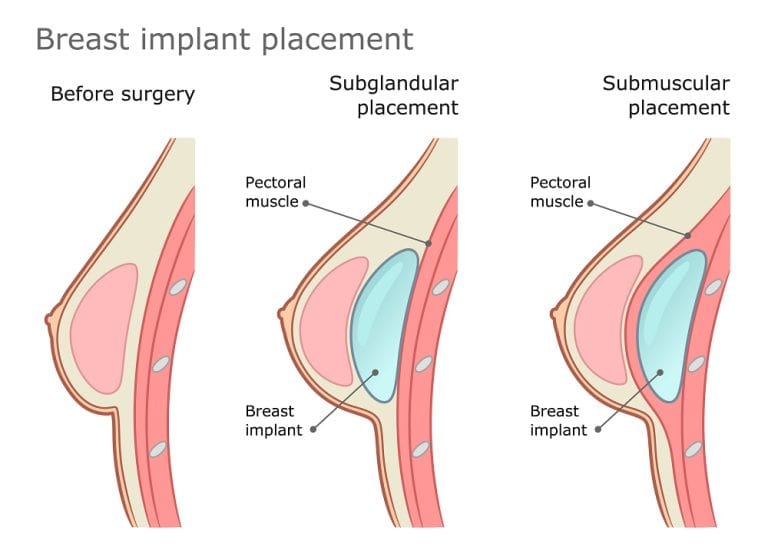 Breast Implants in Troy