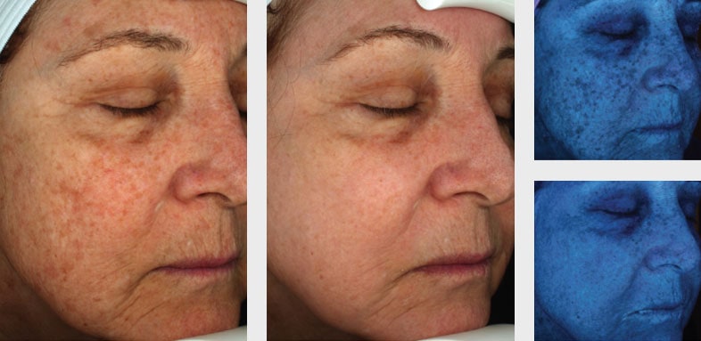 Fractional CO2 Laser Before & After - Charlotte Huntersville, NC: Saluja  Cosmetic and Laser Center