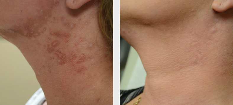 Laser Treatment Patient in Charlotte, NC