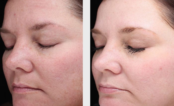 Halo Laser Treatment Patient in Charlotte, NC
