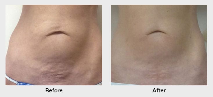 Laser Skin Tightening for Stomach Near Me