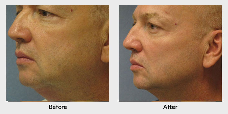 Skin Tightening Before & After - Charlotte Huntersville, NC: Saluja  Cosmetic and Laser Center