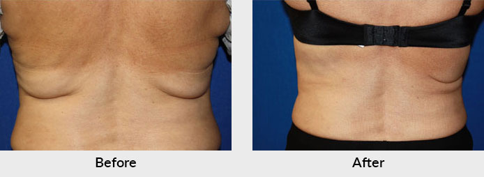 Tummy Skin Tightening - Nuceria Health, Miami, FL