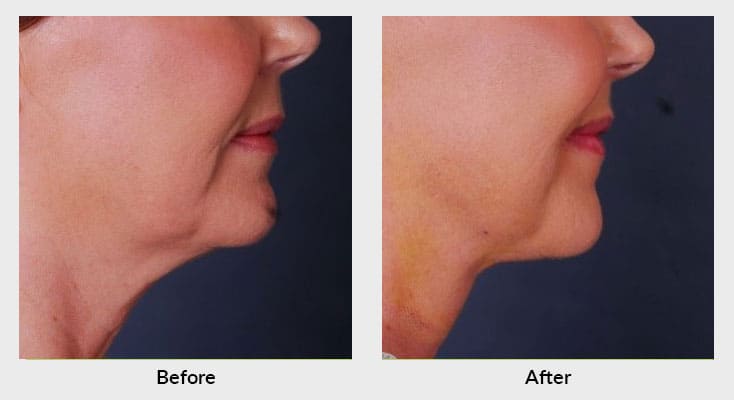 Non-surgical skin tightening in Charlotte, NC