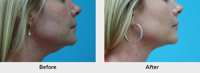 Thermi Skin Tightening Charlotte, NC