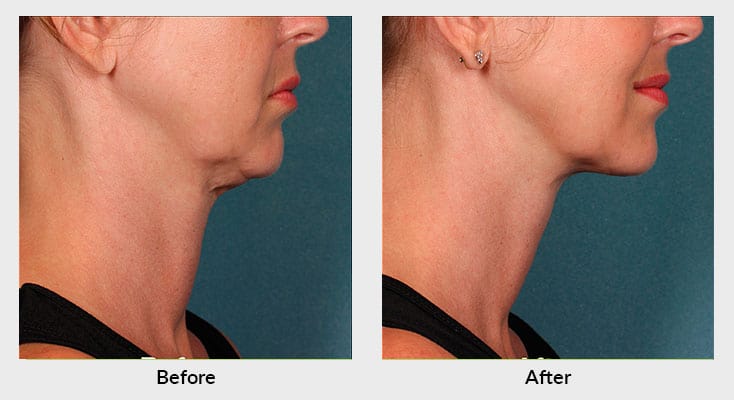 Kybella Patient Charlotte NC