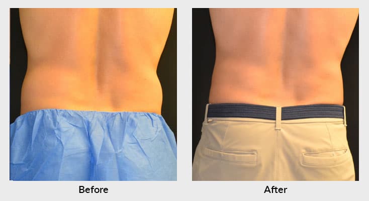 CoolSculpting Lower Body Treatment in Charlotte NC