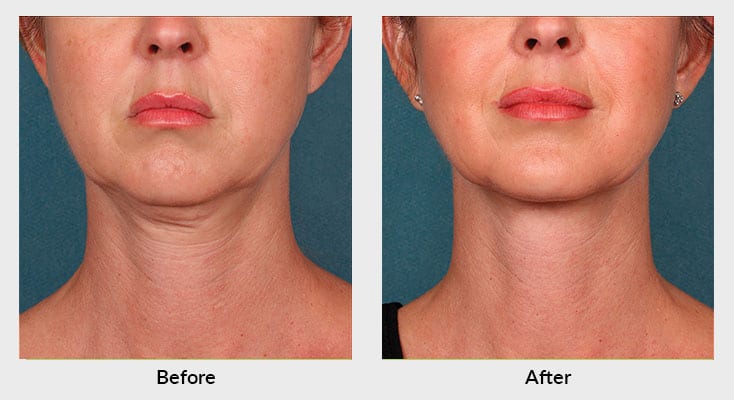 Kybella Patient Charlotte NC