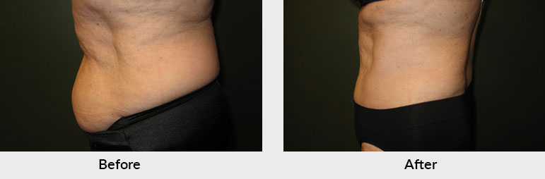 CoolSculpting Abdomen Treatment in Charlotte NC