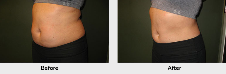 Non Surgical Fat Reduction Female Patient Before & After