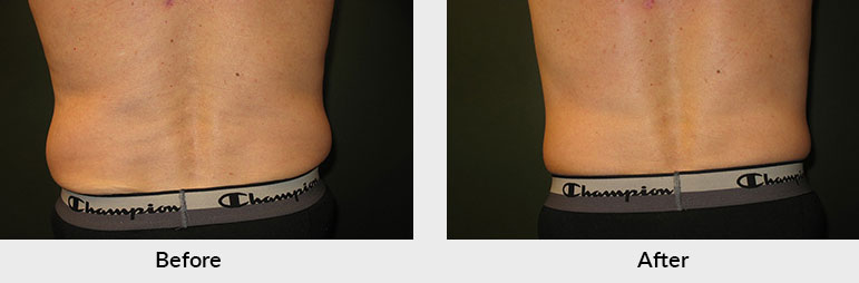 CoolSculpting Male Patient in Charlotte NC