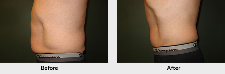 Fat Freezing Male Patient Lower Body Charlotte NC