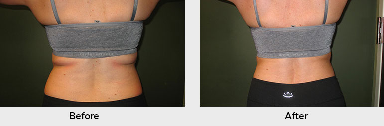 Fat Freezing Patient Lower Body Charlotte NC