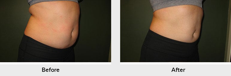 CoolSculpting Patient Photos Charlotte NC