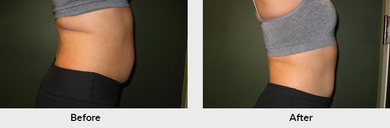 Fat Freezing Patient Charlotte NC