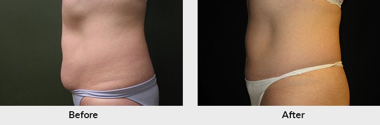 Liposuction Waist and Back Before & After Photos Charlotte North