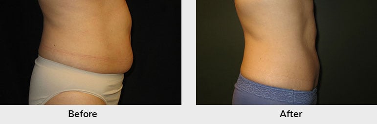 Fat Freezing Charlotte NC