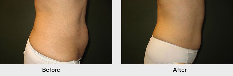 Non Surgical Fat Removal Charlotte NC