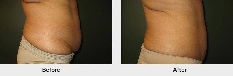 CoolSculpting Charlotte NC