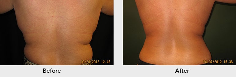 Charlotte CoolSculpting