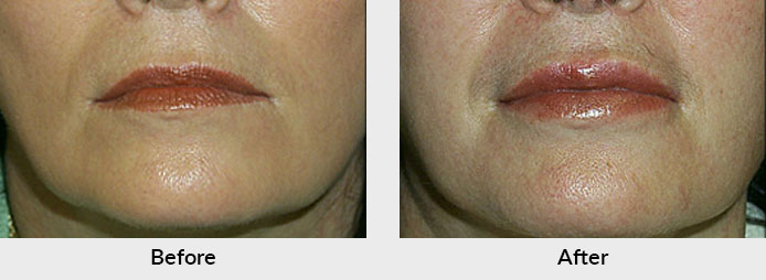 Juvederm lip injections in Charlotte, NC