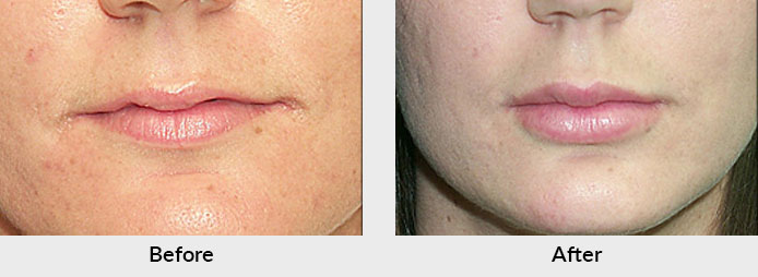 Lip Fat Grafting Charlotte NC