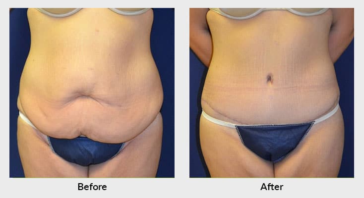 Chicago Body Contouring Surgeons - Plastic Surgery after Weight Loss