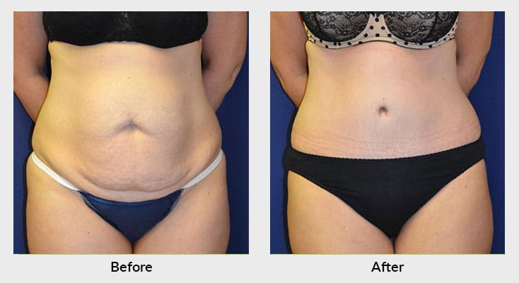 Tummy Tuck Surgery Charlotte - Abdominoplasty Charlotte North Carolina