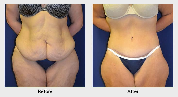 Body Contouring After Weight Loss in Charlotte NC