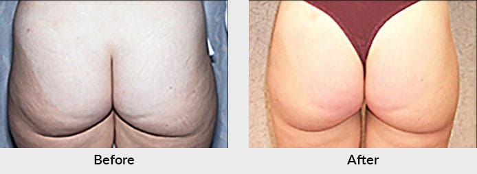 Liposuction Before After Photo in Charlotte, NC