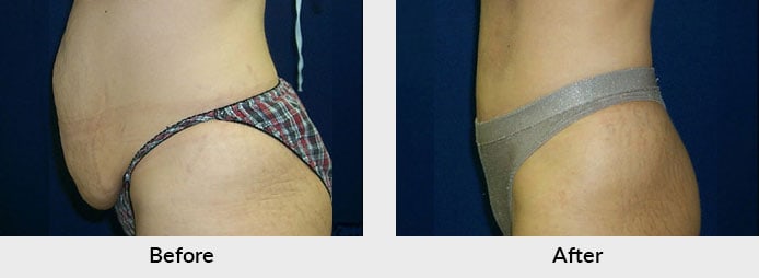 Abdominoplasty Before After Photo in Charlotte, NC