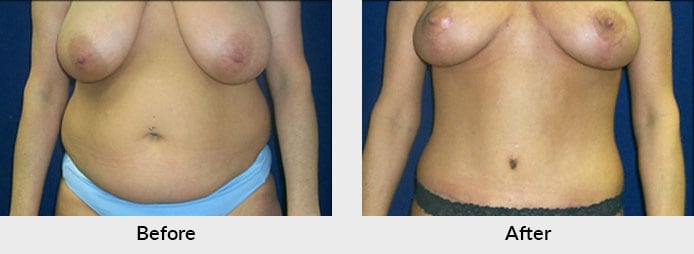 Tummy Tuck in Charlotte NC  Abdominoplasty Plastic Surgeon