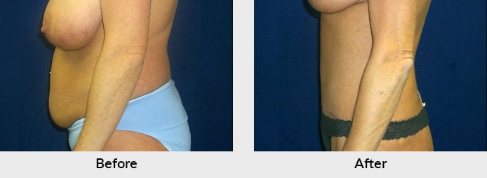 Tummy Tuck Surgery Charlotte - Abdominoplasty Charlotte North Carolina