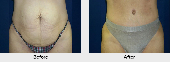 Abdominoplasty Patient in Charlotte, NC