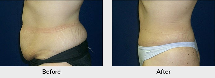 Tummy Tuck Patient in Charlotte, NC