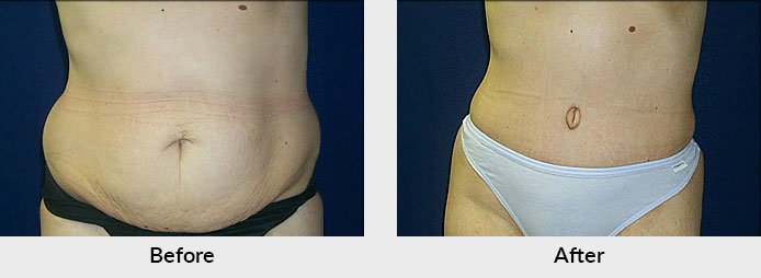 Tummy Tuck in Charlotte, NC