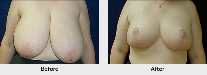 Breast reduction in Charlotte, NC