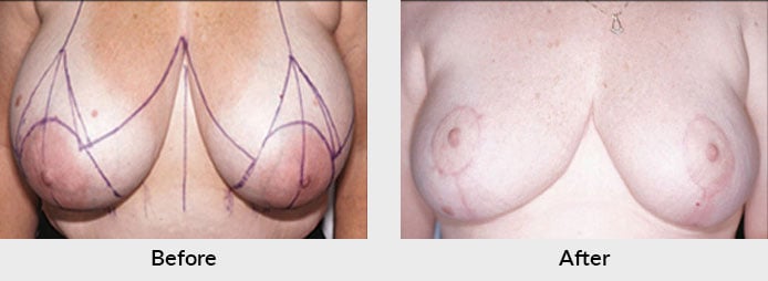 Breast Reduction Patient in Charlotte, NC