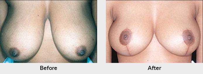 Breast Reduction Before After Photo in Charlotte, NC