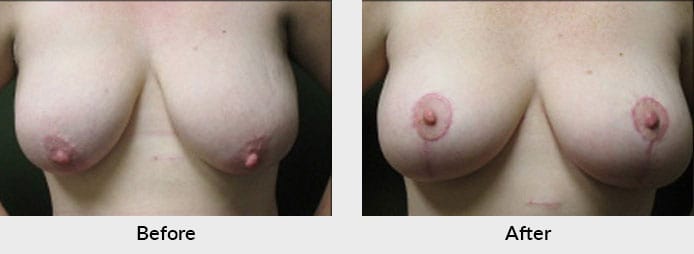 Breast Reduction Patient Results in Charlotte, NC