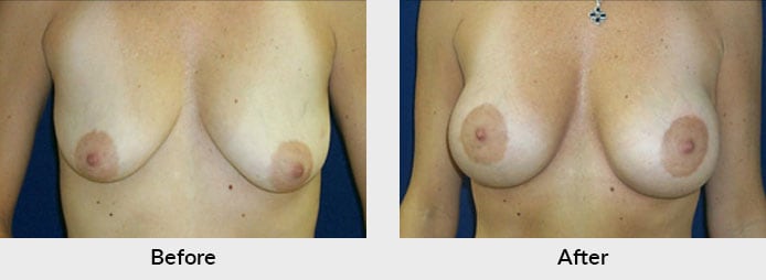 Mastopexy Patient in Charlotte, NC