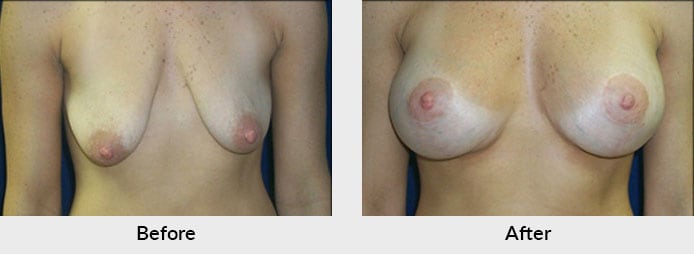 Mastopexy Before & After Photo in Charlotte, NC