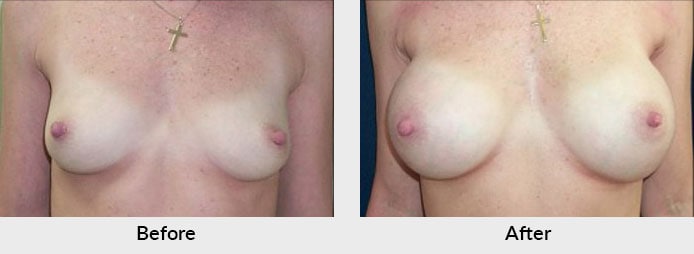 Breast Implants Charlotte, NC