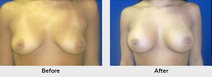 Breast Implant Patient Before After Gallery Charlotte, NC